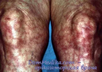 Сітчасте ливедо (livedo reticularis) - діагностика, лікування (лікування) Сітчасте ливедо (livedo reticularis) - діагностика, лікування