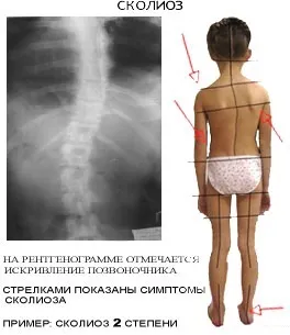 Симптоми, ознаки, причини виникнення сколіозу хребта (симптоми) Симптоми, ознаки, причини виникнення сколіозу хребта
