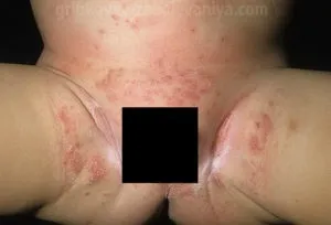 Висип у паху у дітей причини, симптоми, лікування (паху) Висип у паху у дітей причини, симптоми, лікування