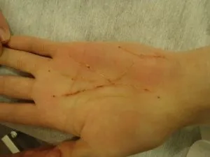 Шрами на долоні в хіромантії (долоні) Шрами на долоні в хіромантії