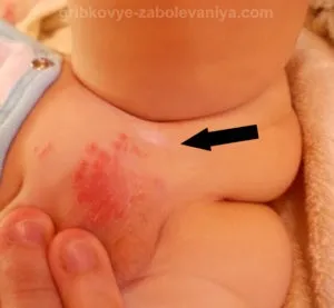 Висип у паху у дітей причини, симптоми, лікування (висип) Висип у паху у дітей причини, симптоми, лікування