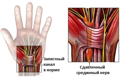 Синдром комп'ютерної миші або тунельний синдром (синдром комп'ютерної миші) Синдром комп'ютерної миші або тунельний синдром