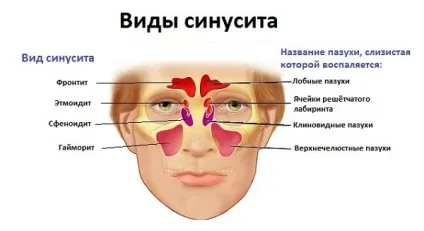 Синусит і гайморит - в чому різниця