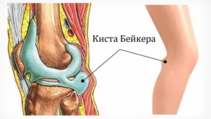 Синовіальная кіста підколінної ямки або кіста Бейкера що робити, методи лікування (підколінної) Синовіальная кіста підколінної ямки або кіста Бейкера що робити, методи лікування