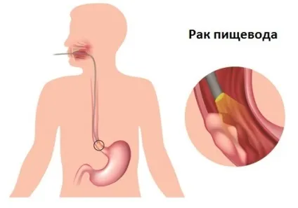 Симптоми основних захворювань стравоходу (стравоходу) Симптоми основних захворювань стравоходу