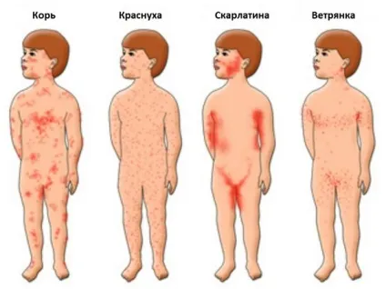 Висип у дитини причини появи висипань і їх лікування (появи) Висип у дитини причини появи висипань і їх лікування