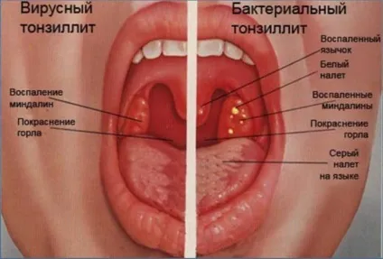 Скільки лікується фарингіт і які його форми (гострий фарингіт можуть) Скільки лікується фарингіт і які його форми