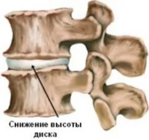 Зниження висоти міжхребцевих дисків - чим це загрожує