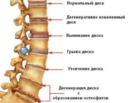 Зниження висоти міжхребцевих дисків причини, симптоми, лікування (зниження) Зниження висоти міжхребцевих дисків причини, симптоми, лікування