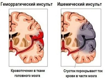 Стентування судин головного мозку підготовка, проведення, реабілітація (судин) Стентування судин головного мозку підготовка, проведення, реабілітація