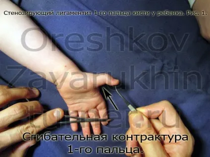 стенозуючий лігаментит