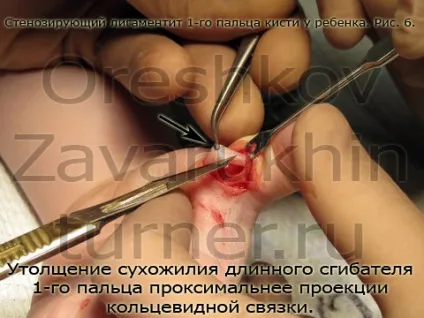 стенозуючий лігаментит