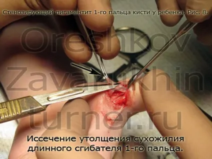 стенозуючий лігаментит