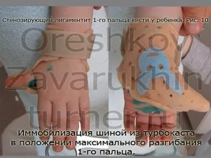 стенозуючий лігаментит