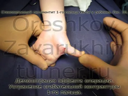 стенозуючий лігаментит