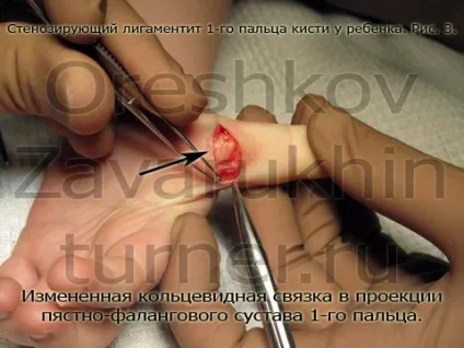 стенозуючий лігаментит