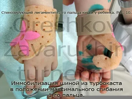 стенозуючий лігаментит