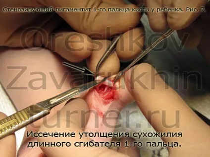 стенозуючий лігаментит