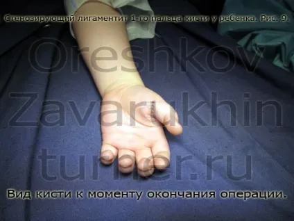 стенозуючий лігаментит