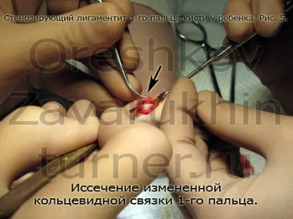 стенозуючий лігаментит