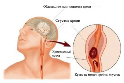 Стовбурової інсульт що це, прогноз, наслідки, здоров'я вашої голови (наслідки) Стовбурової інсульт що це, прогноз, наслідки, здоров'я вашої голови