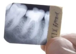 Свищ на яснах лікування і причини появи (причини) Свищ на яснах лікування і причини появи