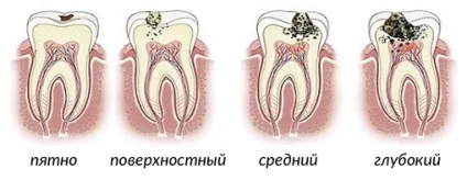Свищ на яснах лікування і причини появи (причини) Свищ на яснах лікування і причини появи