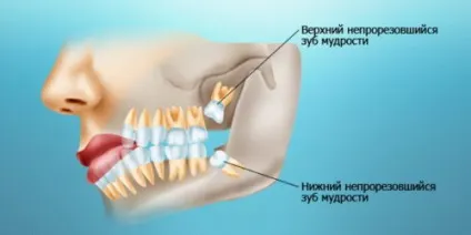 Свищ на яснах лікування і причини появи (яснах) Свищ на яснах лікування і причини появи