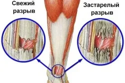 Травми ахіллового сухожилля симптоми і лікування (сухожилля) Травми ахіллового сухожилля симптоми і лікування
