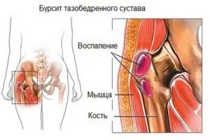Трохантеріт тазостегнового суглоба - лікування, симптоми, прогноз і до якого лікаря звертатися з (трохантеріт тазостегнового суглоба лікування симптоми прогноз вертельной бурсит лікар) Трохантеріт тазостегнового суглоба - лікування, симптоми, прогноз і до якого лікаря звертатися з