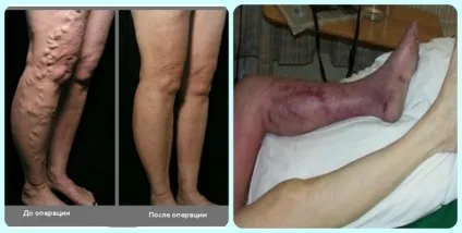Видалення тромбу - судинна хірургія, trombanet (видалити тромб операція) Видалення тромбу - судинна хірургія, trombanet