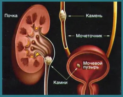 Видалення каменів з сечового міхура (для чоловіків) Видалення каменів з сечового міхура
