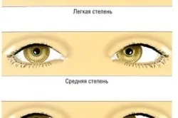 Вправи для очей при косоокості у дітей (дітей) Вправи для очей при косоокості у дітей