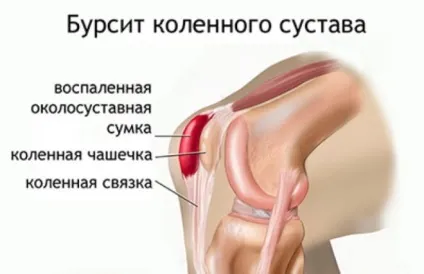 Забій коліна при падінні лікування в домашніх умовах (домашніх) Забій коліна при падінні лікування в домашніх умовах