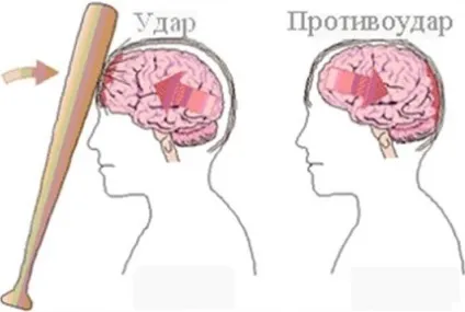 Забій головного мозку симптоми, наслідки, лікування (мозку) Забій головного мозку симптоми, наслідки, лікування