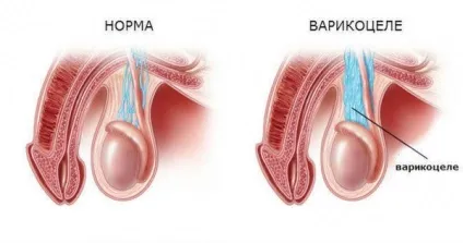 Варикоз яєчок у чоловіків у підлітків, симптоми, наслідки, лікування, фото