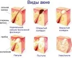 Види вугрів фото, стероїдні, кулясті (кулясті) Види вугрів фото, стероїдні, кулясті