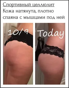 Види целюліту, фото, характеристики і способи їх лікування, гладке тіло