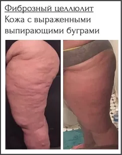 Види целюліту, фото, характеристики і способи їх лікування, гладке тіло
