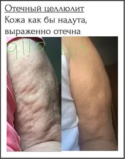 Види целюліту, фото, характеристики і способи їх лікування, гладке тіло