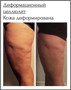 Види целюліту, фото, характеристики і способи їх лікування, гладке тіло