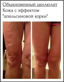Види целюліту, фото, характеристики і способи їх лікування, гладке тіло