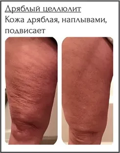 Види целюліту, фото, характеристики і способи їх лікування, гладке тіло