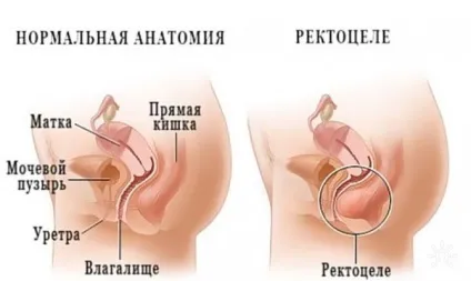 Випадання або опущення передньої і задньої стінок піхви - причини, лікування, видалення, симптоми (піхви) Випадання або опущення передньої і задньої стінок піхви - причини, лікування, видалення, симптоми
