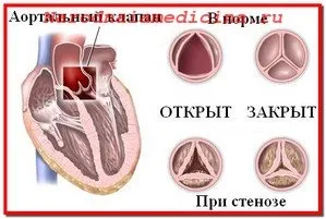 аортальний стеноз