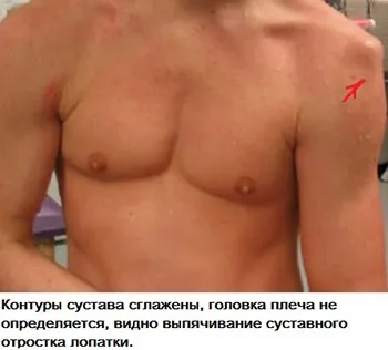 Вивих плечового суглоба симптоми, лікування і операція, вправи для реабілітації суглоба плеча (суглоба) Вивих плечового суглоба симптоми, лікування і операція, вправи для реабілітації суглоба плеча