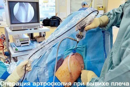 Вивих плечового суглоба симптоми, лікування і операція, вправи для реабілітації суглоба плеча (суглоба) Вивих плечового суглоба симптоми, лікування і операція, вправи для реабілітації суглоба плеча