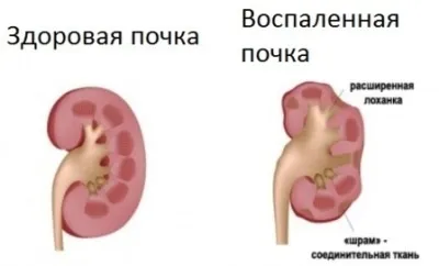 Запалення нирок лікування народними засобами (запалення) Запалення нирок лікування народними засобами
