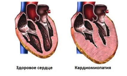 вторинна кардіоміопатія
