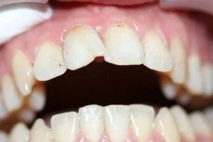 Художня реставрація зубів композитним матеріалом, фото до і після (реставрація) Художня реставрація зубів композитним матеріалом, фото до і після